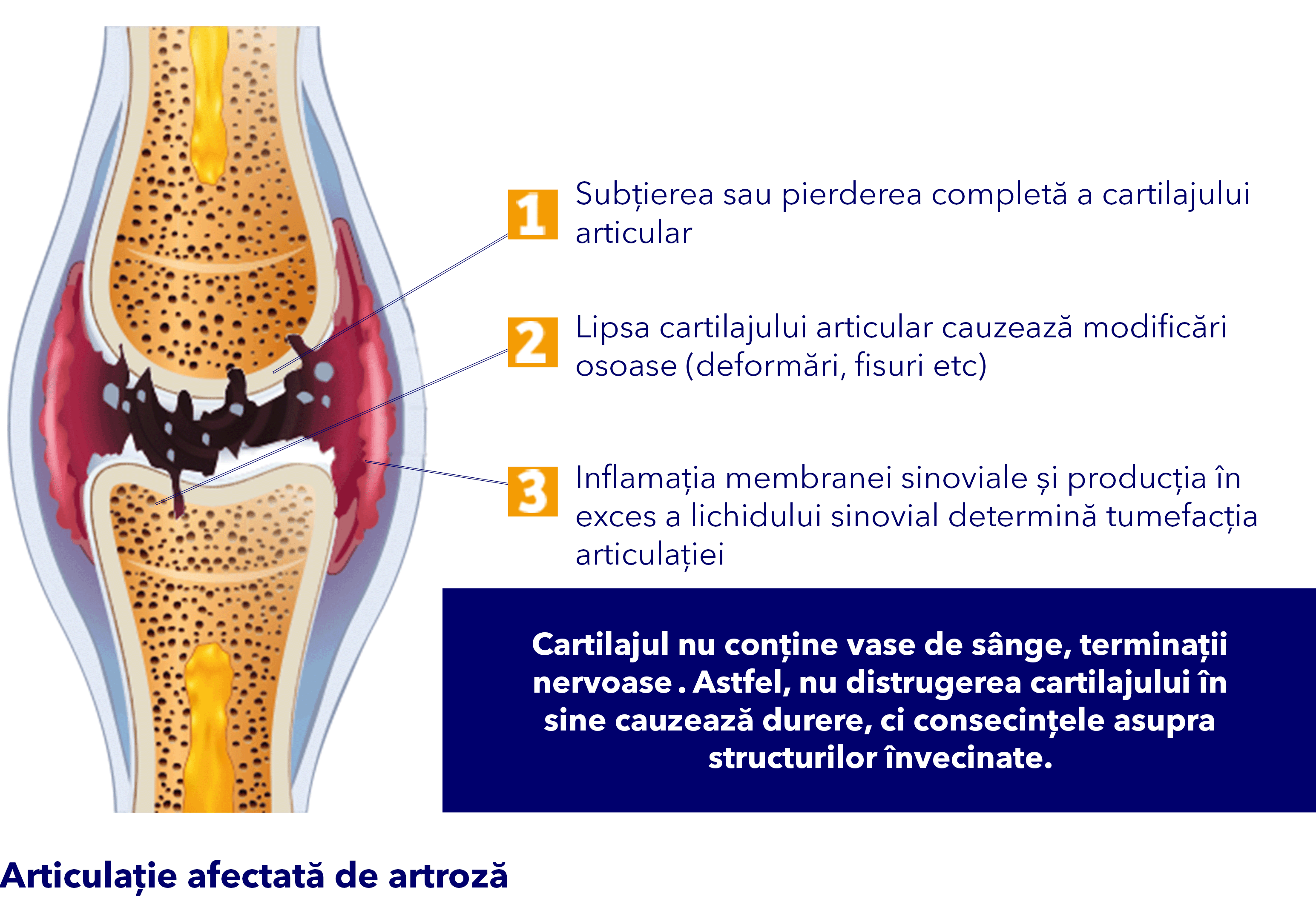 articulation avec de l'arthrose